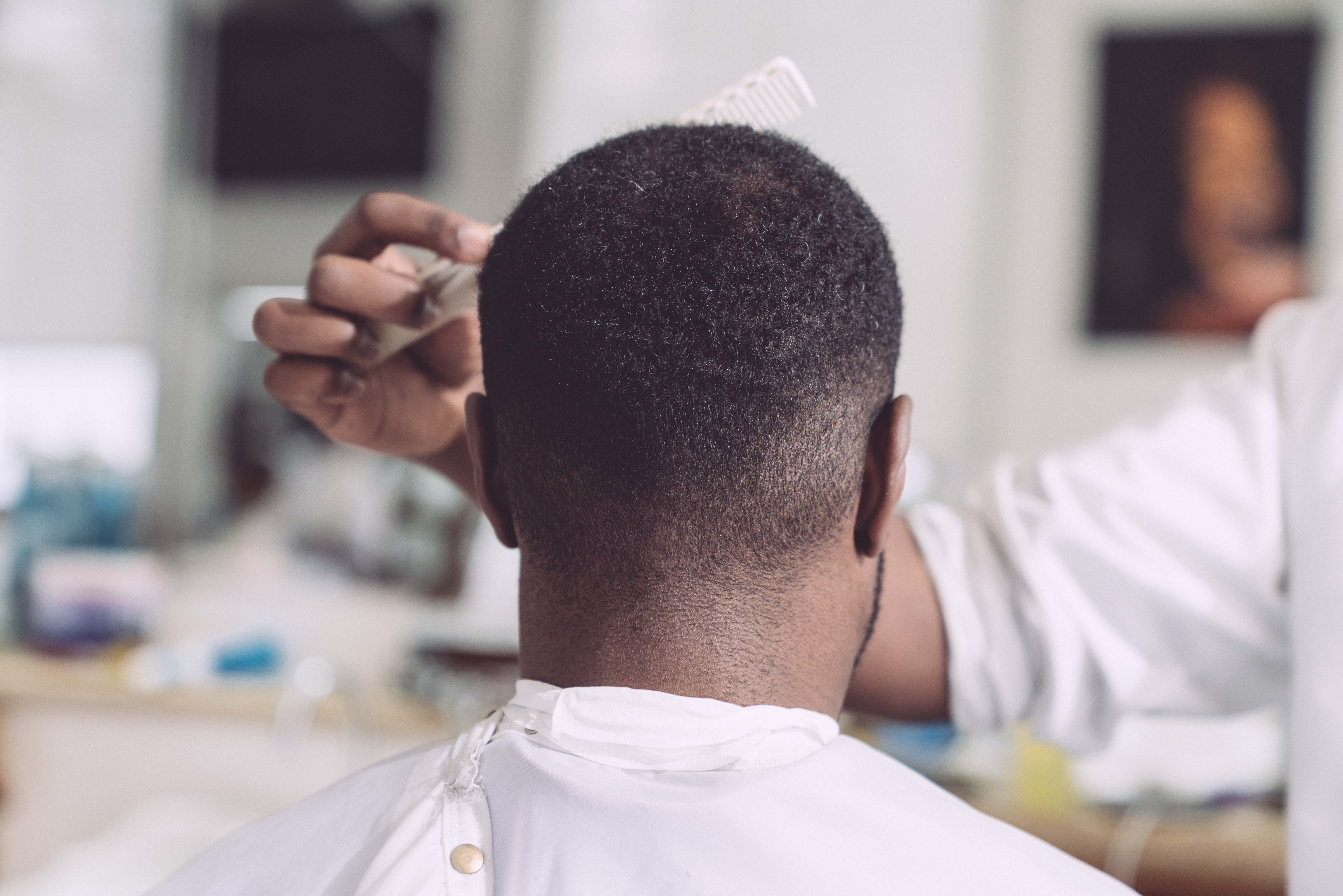Haartransplantation im Check