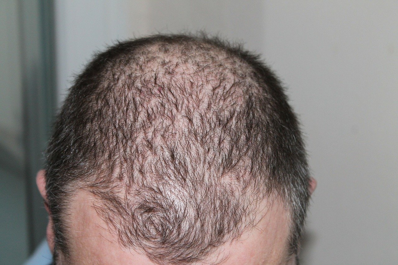 Haartransplantation in der Türkei